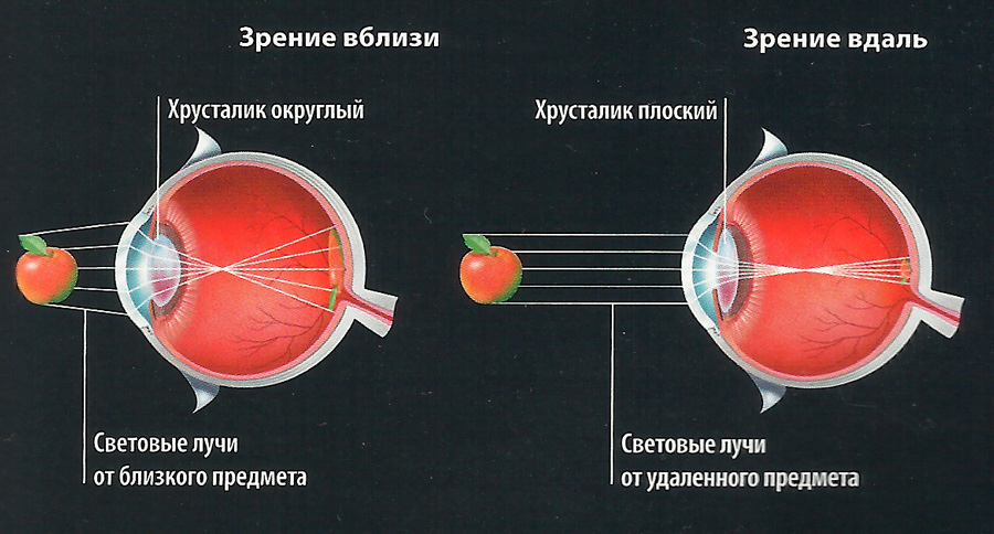 При дальнозоркости изображение возникает перед сетчаткой на сетчатке