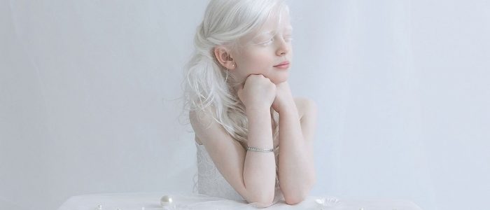 какие глаза бывают у альбиносов. Смотреть фото какие глаза бывают у альбиносов. Смотреть картинку какие глаза бывают у альбиносов. Картинка про какие глаза бывают у альбиносов. Фото какие глаза бывают у альбиносов