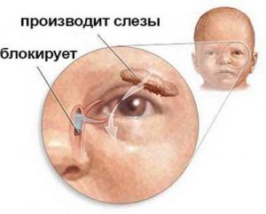 Дакриоцистит