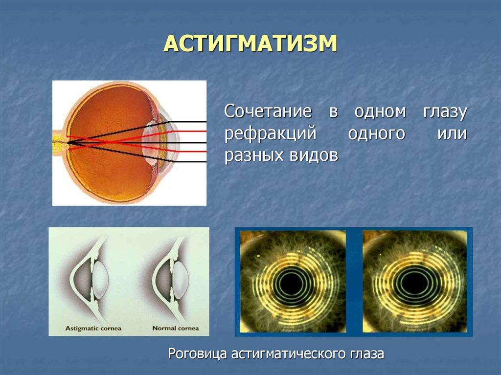 Что такое сложный миопический астигматизм. Миопический роговичный астигматизм. Астигматический цилиндр. Строение глаза астигматизм. Заболевание глаз астигматизм.