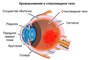 Гемофтальм