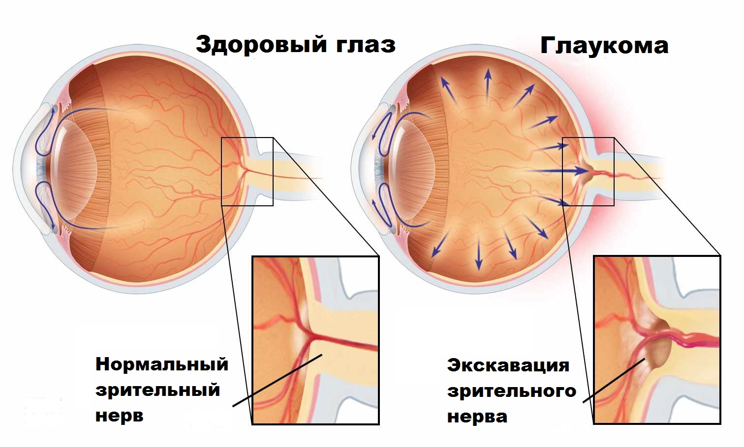 Глазное давление боль