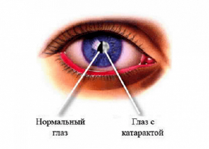 Катаракта
