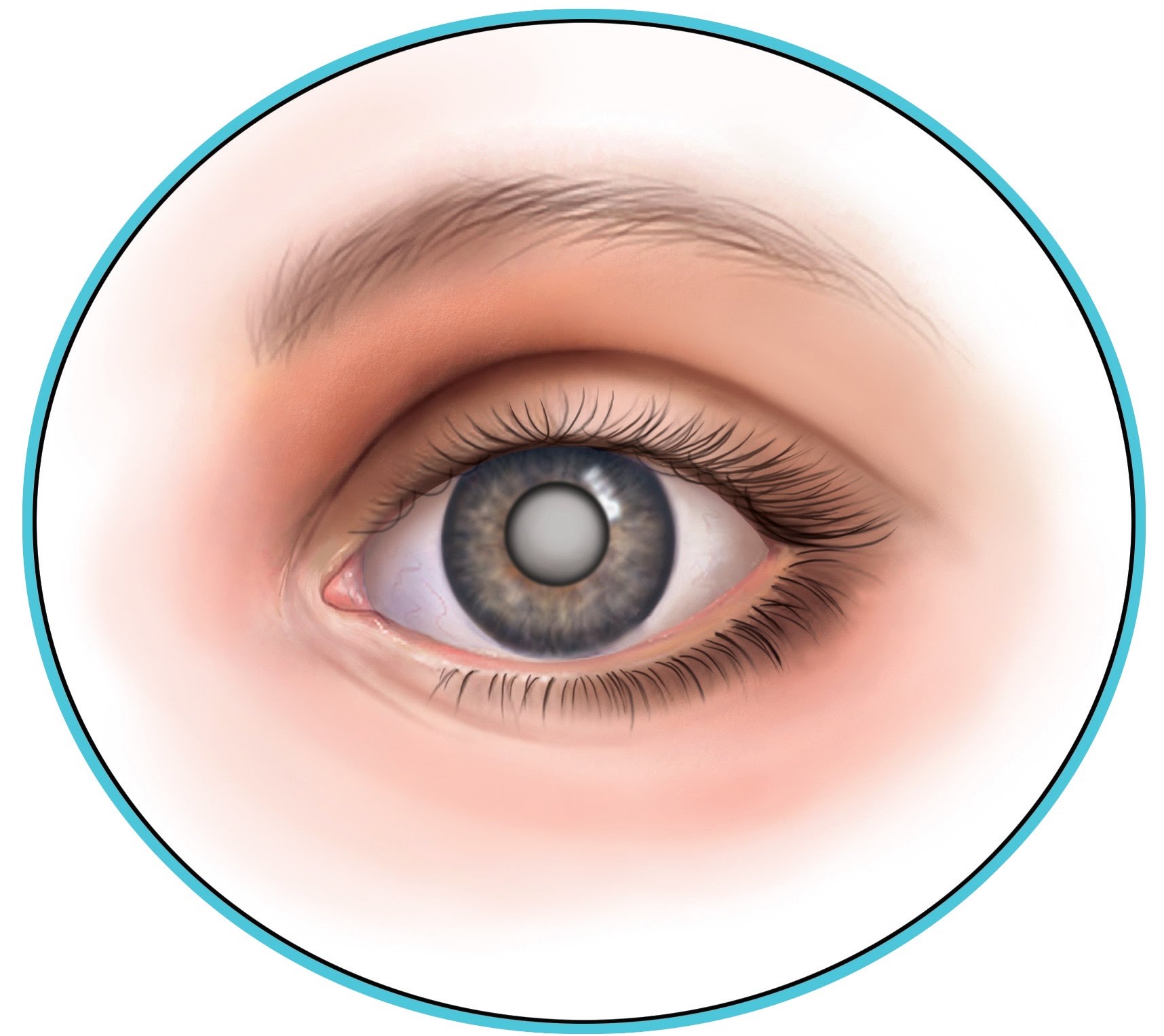 Глаз т в. Катаракта помутнение хрусталика. Глазная болезнь катаракта. Катаракта глаза симптомы.