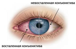 Коньюктивит