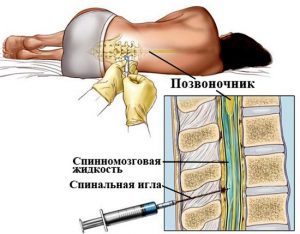 Люмбальная пункция