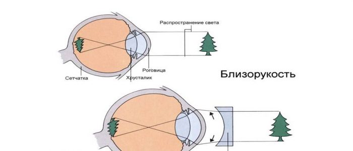 Миопия слабой степени: лечение, этиология, осложнения