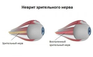 Неврит зрительного нерва