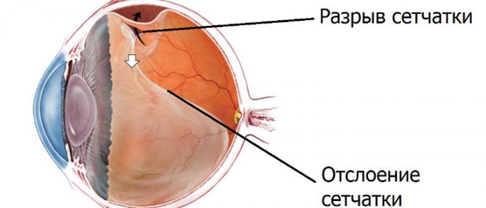 Если глаз строит изображение далеких предметов за сетчаткой то глаз страдает