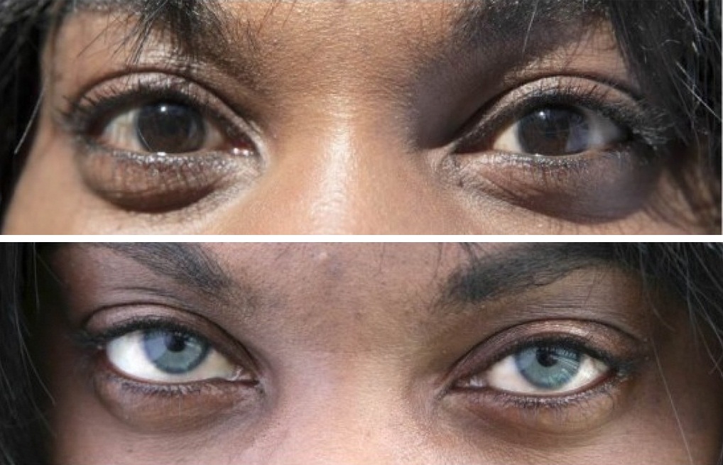 Черные глаза операция. Изменение цвета глаз. Изменение цвета глаз лазером. Операция по смене цвета глаз. Изменение карего цвета глаз.
