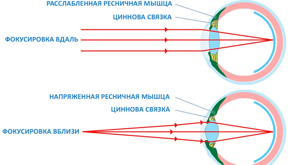 Где формируется изображение у дальнозорких людей