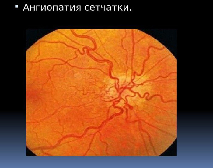 лечение гипертонической ангиопатии сетчатки глаза