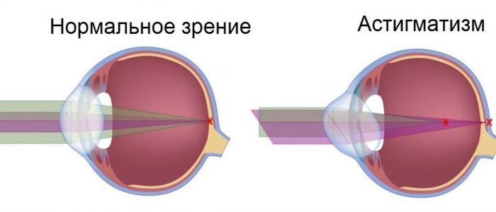 Астигматизм фото глаз и сравнение со здоровым