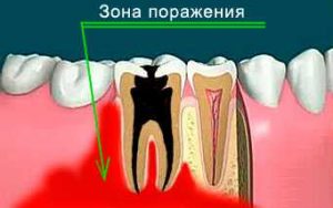 Остеомиелит челюсти