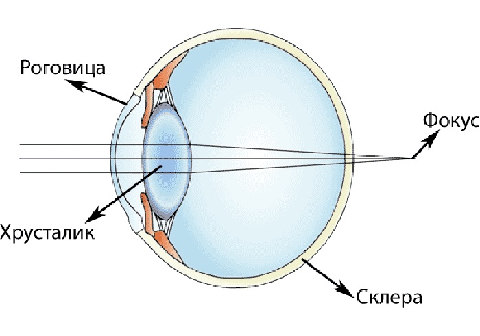Фокусировка глаза человека. Дальнозоркость роговица. Гиперметропия схема глаза. Дальнозоркость и близорукость строение глаза. Глаз при дальнозоркости.