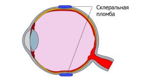 Экстрасклеральное пломбирование