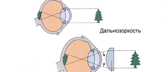 Пина на фоне гиперметропии