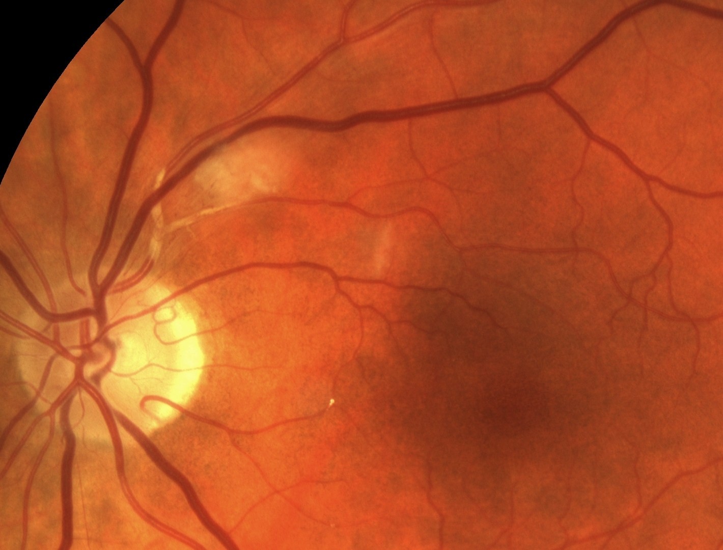 Изменение на глазном дне. Гипертоническая ангиопатия сетчатки. Ангиоспастическая ретинопатия. Ангиопатия и ретинопатия сетчатки. Ангиопатия сетчатки глаза ou.