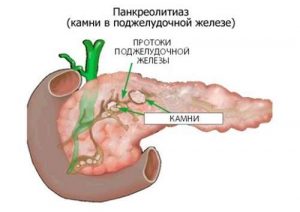 Камни в поджелудочной железе