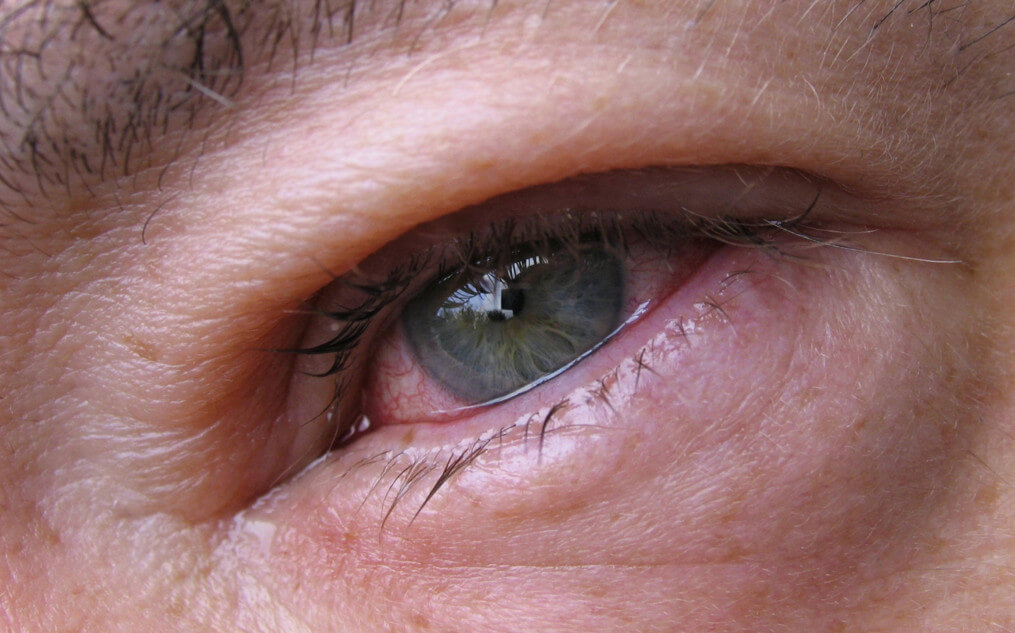 Тобримед - глазные капли: инструкция, нежелательные реакции