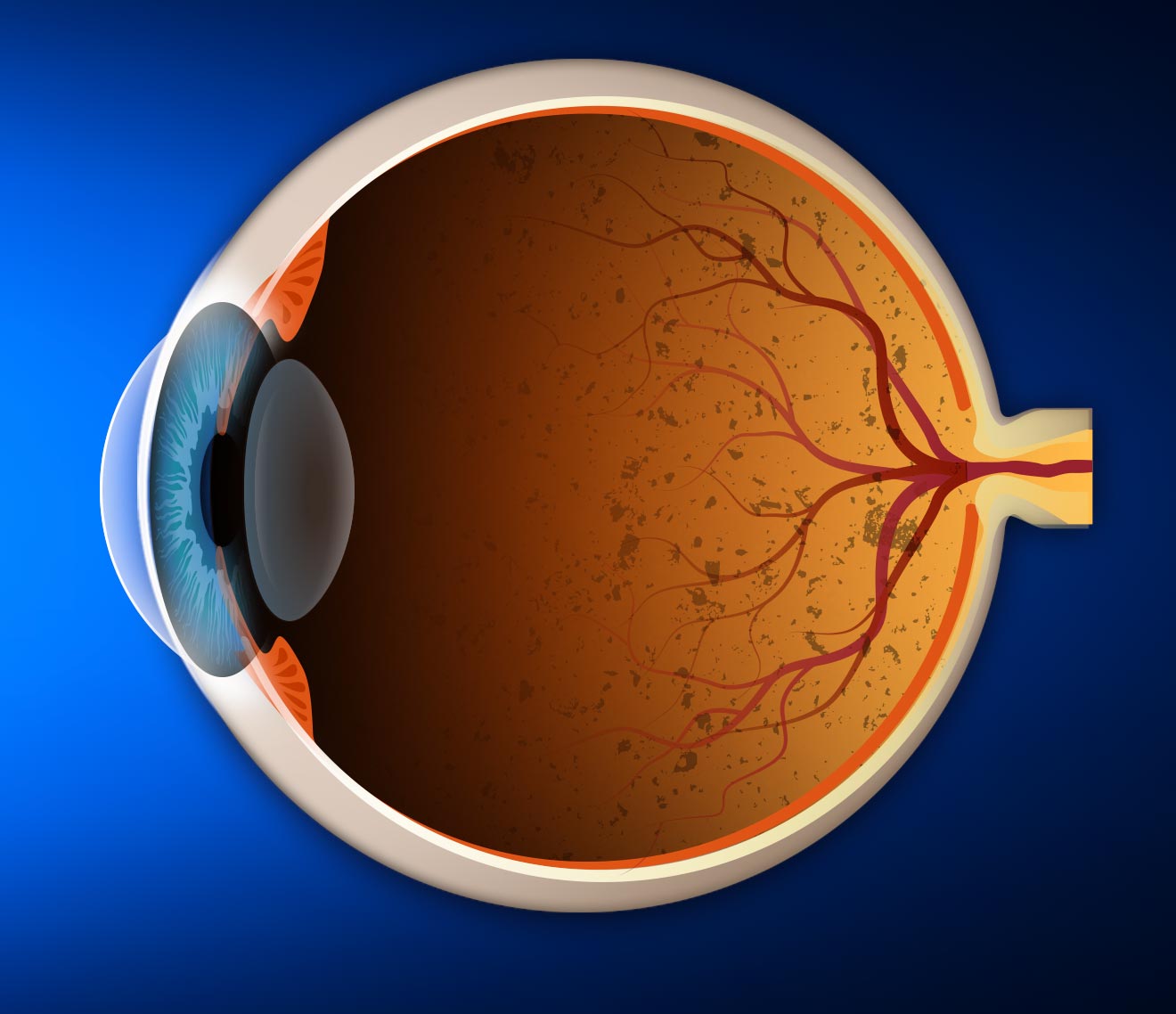 На сетчатке глаза формируется. Пигментный ретинит сетчатки. Пигментная дегенерация сетчатки глаза. Пигментная дистрофия (ретинит). Пигментная абиотрофия сетчатки.
