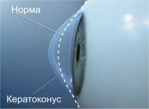 Кератоконус